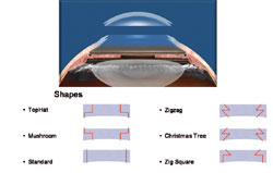 Figure1. Various schematic shapes of FLEK procedure