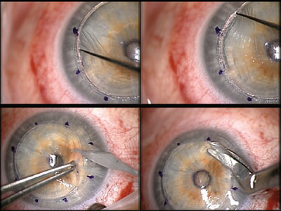 Figure 3. Completion of the gentle dissection of the corneal tissue bridges