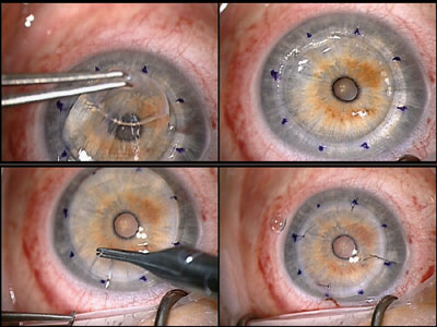 Figure 4. The central full-thickness corneal disc is removed using 0.12 forceps