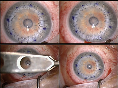 Figure 5. After the cardinal sutures, the 24-bite, running 10-0 nylon suture is placed