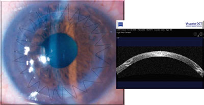 Displays of the clinical biomicroscopic and OCT views of a FLEK procedure