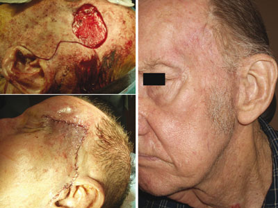 Figure 1. Cervicofacial flap with facelift approach