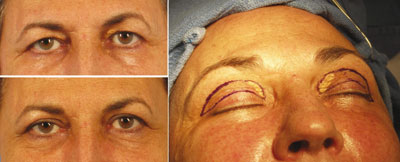 Figure 3. Removal of xanthelasma