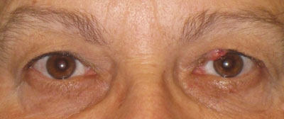 Figure 1. External photograph of both eyes