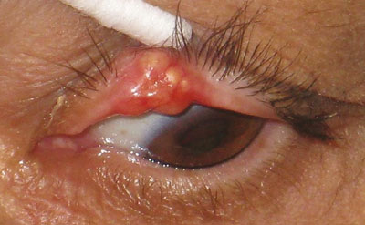 Figure 2. External photograph of left eye, with aversion of upper lid