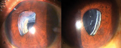 Figures 1a and 1b. Slit lamp photograph showing subluxation of the right and left eyes