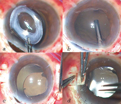 Figures 2a-2d. Surgical procedure showing explantation of the IOL