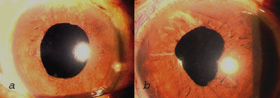 Figures 3a and 3b. Postoperative slit lamp photograph of right and left eyes