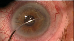 Figure 1. After the cornea is marked