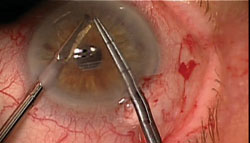 Figure 2. An inferior peripheral iridotomy