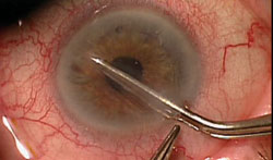 Figure 3. The donor lenticule in a 30/70 taco fold is inserted