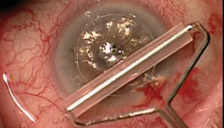 Figure 4. A 100% air bubble is injected into the anterior chamber