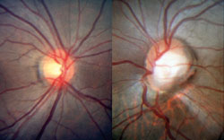 Figure 1. Right and left optic discs