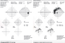 Figure 2. Humphrey visual field 24-2 SITA standard of left and right eyes