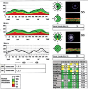 Figure 3. OCT measurements and images of the right and left eyes