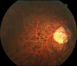 Figure 2. Myopic fundus with tilted nerve