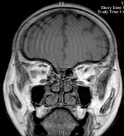 Figure 3. Medially displaced superior rectus