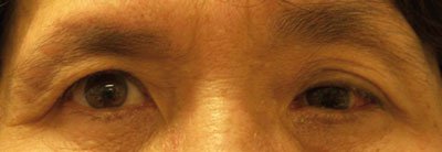 Improvement in left eye position with remaining esotropia