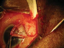 Deep scleral trabeculectomy flap