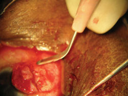 Trabeculectomy flap closed 