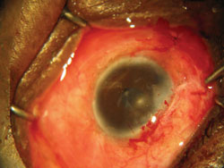 Conjunctival wound is closed