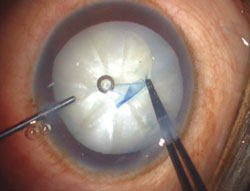 Figure 1. Capsulorrhexis running away to the periphery