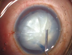 Figure 2. Hydrodissection done and nucleus prolapsed