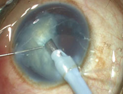 Figure 3. Nucleus being removed by phacoemulsification