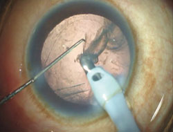 Figure 4. Irrigation and aspiration being performed in Cap Vac mode