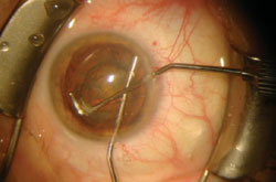 Figure 2. The second prechopper is inserted through the cataract incision