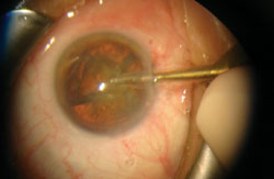 Figure 7. This shows one quadrant on the phaco tip