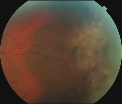 Figure 1. A peripheral, flat choroidal nevus in the temporal retina