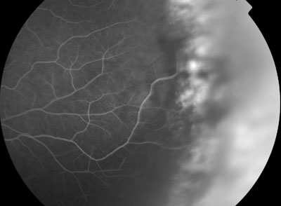 Figure 2. Mid-phase fluorescein angiogram of the temporal retina