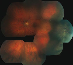 Figure 4. Mosaic fundus photo after gamma knife radiation