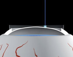 The calculated ablation volume is removed with the Schwind Amaris laser