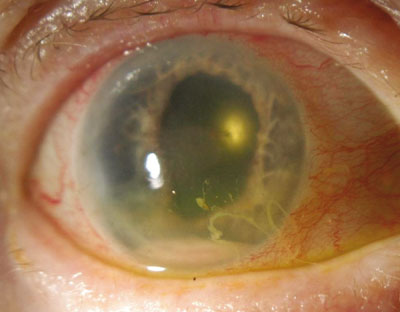 Figure 1. Mild diffuse corneal haze