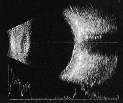 Figure 2. B-scan ultrasonography