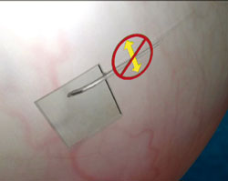 Figure 2b. Transverse axis movement is prevented by the scleral tuck