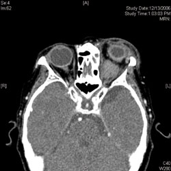 Figure 2. CT scan of orbits without contrast, axial cut