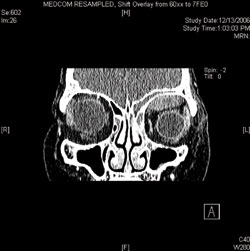 Figure 3. CT scan of orbits without contrast, coronal cut