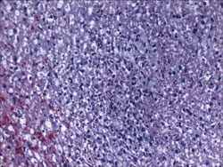 Figure 4. Pathology specimen stained with hematoxylin and eosin