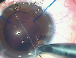 Straight needle with the 10-0 Prolene suture