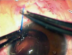 Suture is pulled through as leading haptic pushes the capsular bag against the eye wall