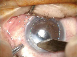 Before the amniotic membrane is sutured to the recipient cornea