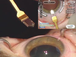 Figure 1. A diamond keratome is use to make a 1.8-mm clear corneal incision