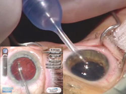 Figure 2. New instrumentation facilitates the transition to microincision cataract surgery