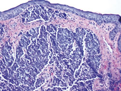 Figure 2. Hematoxylin and eosin stain showing large nests of monomorphic cells