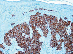 Figure 3. Positive cytokeratin-20 histochemical marker