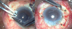 Figure 2. Scleral flaps