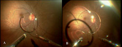 Figure 3. Fundus showing technique